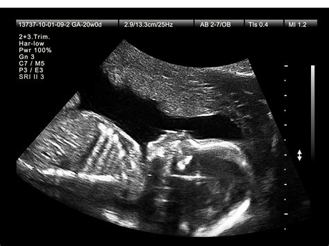 20-week ultrasound tips image