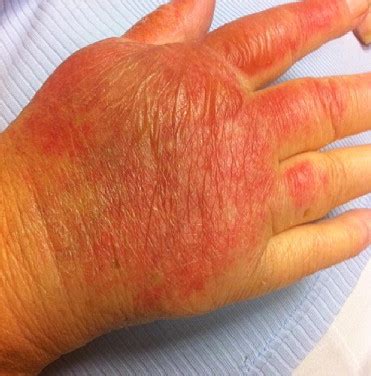 2nd degree burn healing stages
