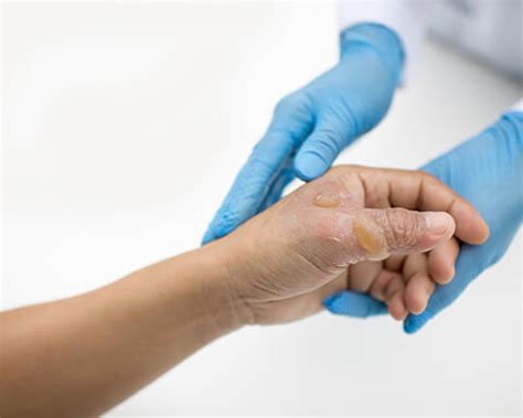 2nd degree burn treatment