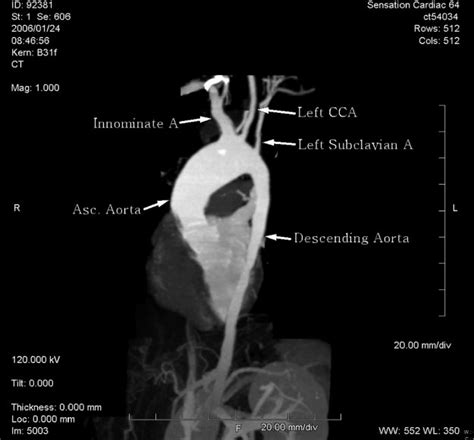 5 Ct Angiogram Chest Tips for Patients