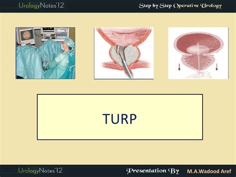 5 Tips for TURP