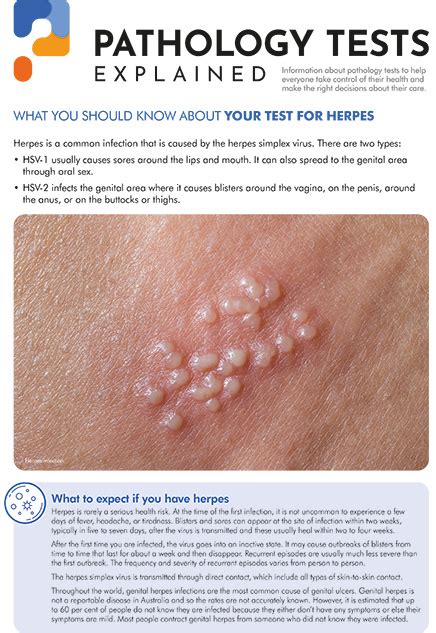 5 Tips for Testing HSV-1 and HSV-2