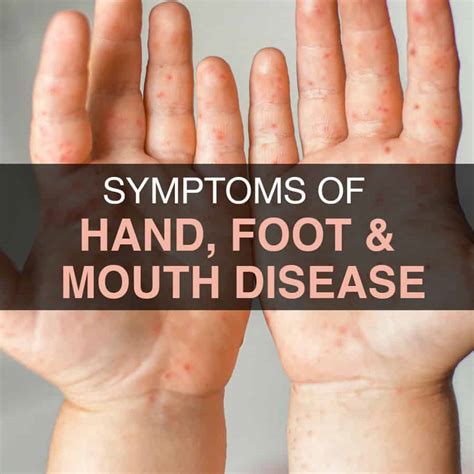 5 Ways to Cure Hand Foot Mouth Disease