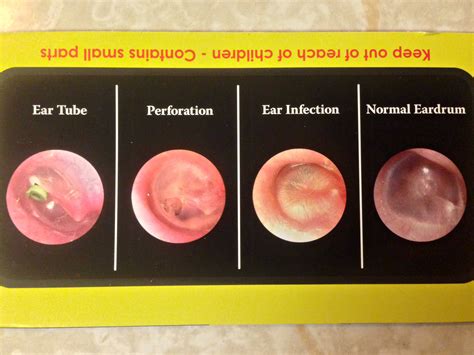 5 Ways to Fix Fluid Ear
