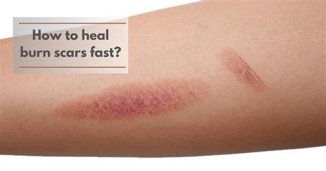 5 Ways to Soothe Burns Fast