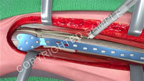 5 Tips for Orif Surgery