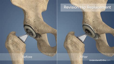 5 Tips for Hip Replacement