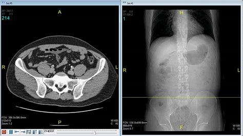 5 Ways Abdominal CT Scan Can Help