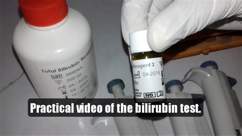 5 Ways Bilirubin Test