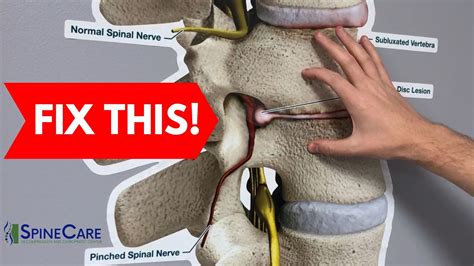 5 Ways to Fix a Bulging Disc