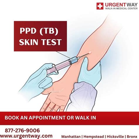 5 ways PPD skin test is used