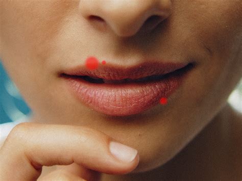 5 Ways to Fix Lip Cold Sores