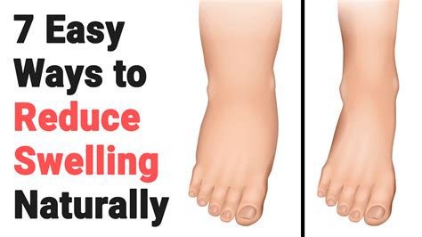 5 Ways to Reduce Swelling