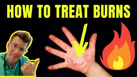 5 ways to treat burns