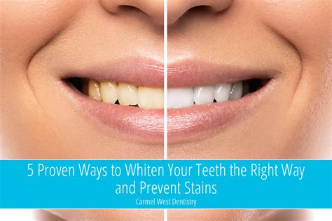 5 Ways to Whiten Teeth