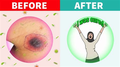 7 Ways to Treat Ulcers