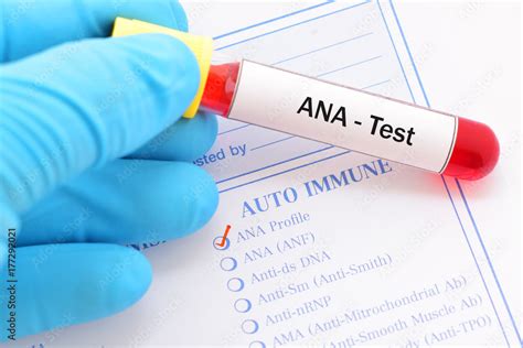 ANA Test