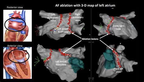Ablation procedure