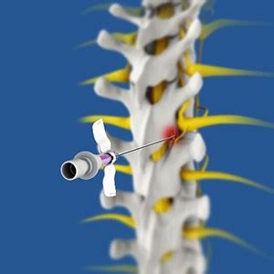 Ablation Therapy For Back Pain Relief