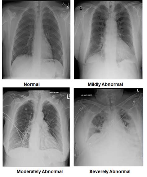 Abnormal Chest X-Ray Image