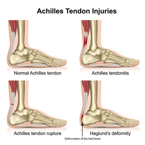 Achilles Heel Tear Symptoms