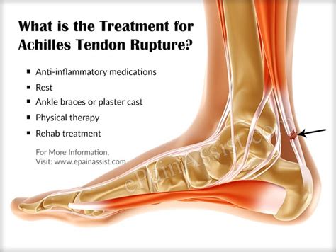 Achilles Tendon Tear Symptoms
