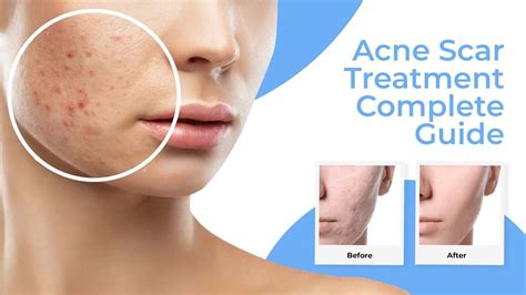 Acne Scar Treatment