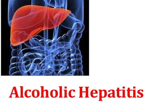 Alcoholic Hepatitis