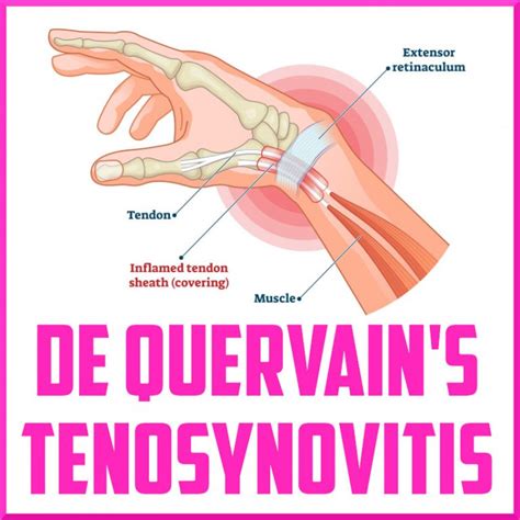 Alternative Treatments for De Quervain's Tenosynovitis