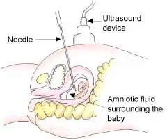 Alternatives to Amniocentesis