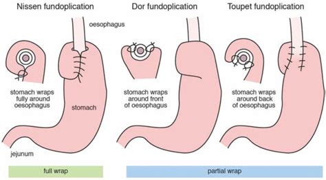 Alternatives to Reflux Surgery