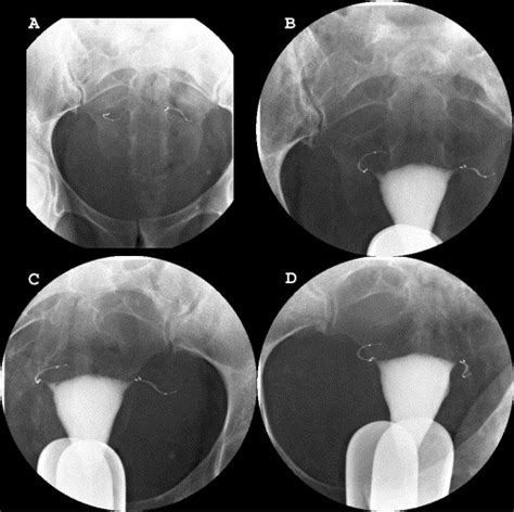 Alternatives to Tubal Ligation
