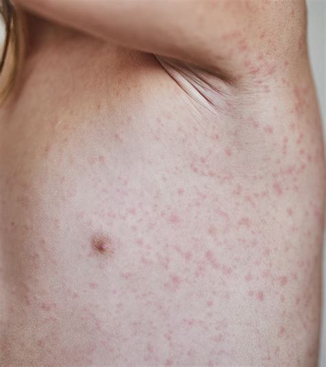Amoxicillin Allergy