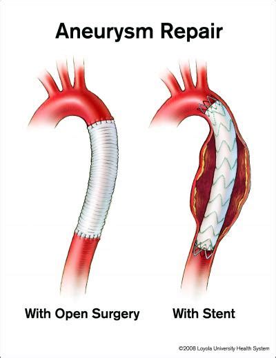 Aneurysm Surgery FAQs