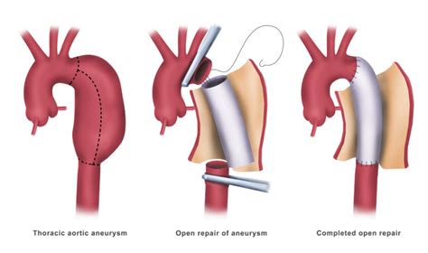 Aneurysm Surgery Preparation