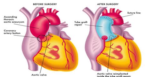 Aneurysm Surgery Risks
