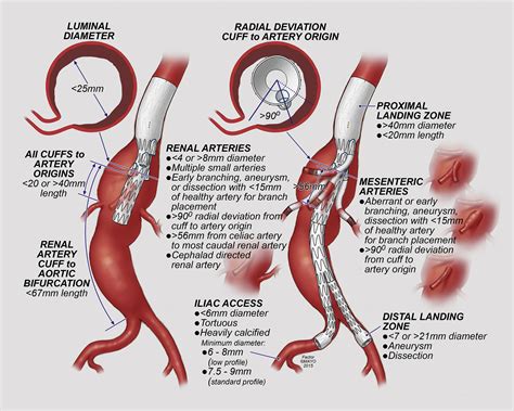 Aneurysm Surgery Tips