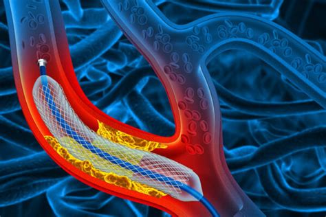 Angiogram Procedure