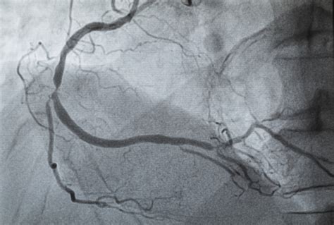 Angiogram and Other Medical Conditions