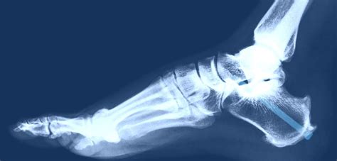 Ankle Fusion Surgery Cost