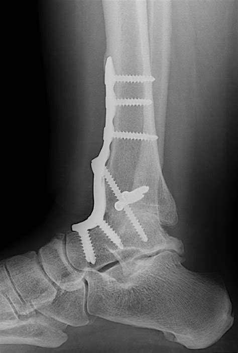 Ankle Fusion Surgery Procedure