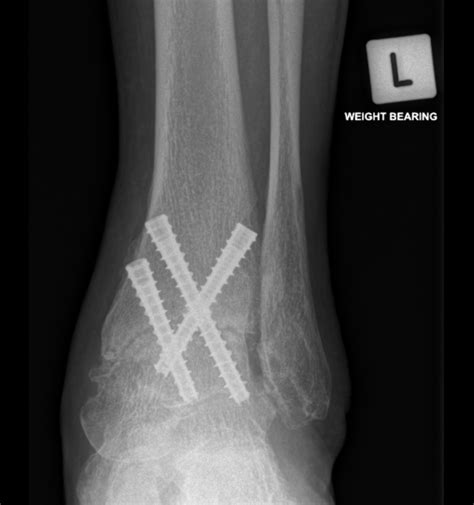 Ankle Fusion Surgery Benefits