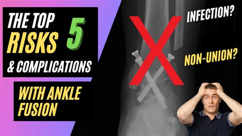 Ankle Fusion Surgery Risks and Complications