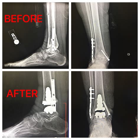Ankle Fusion Surgery Success Rate