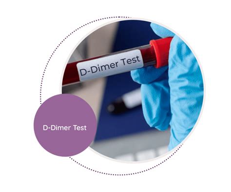 Applications of the D Dimer Test