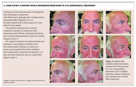 Applying 5 Fluorouracil Cream