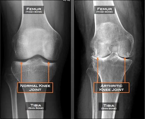 Arthritic Knees