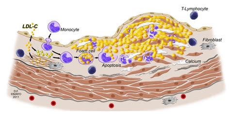 Atherosclerosis Research