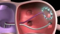 Atrial Fibrillation Ablation FAQs
