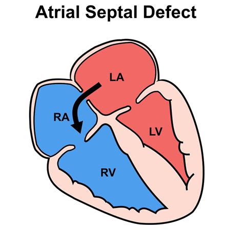 Atrial Septal Defect
